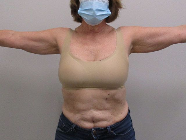 Brachioplasty Before & After