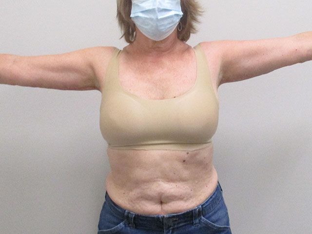 Brachioplasty Before & After