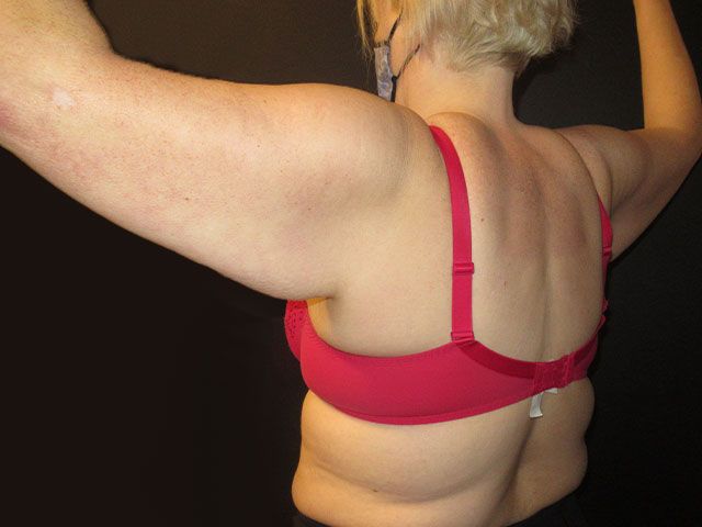 Brachioplasty Before & After