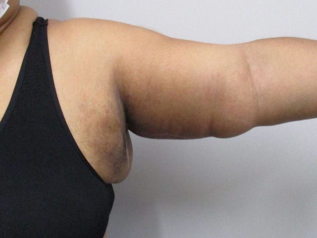 Brachioplasty Before & After