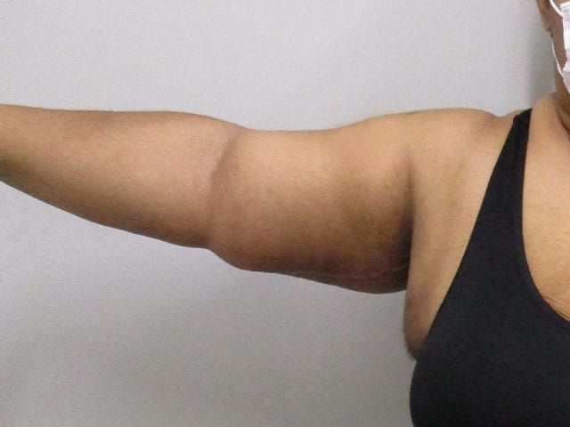 Brachioplasty Before & After