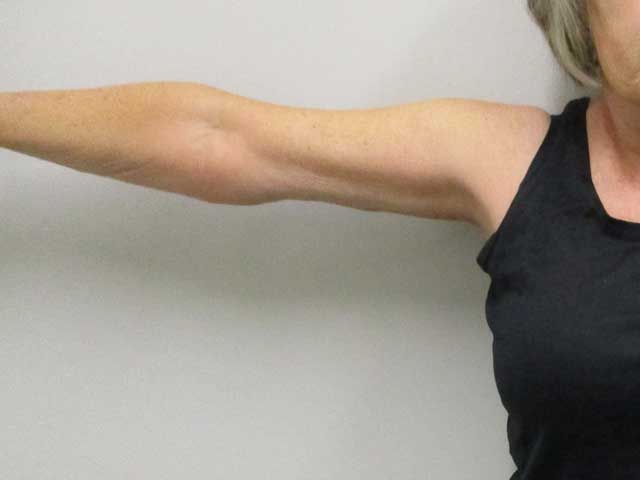 Brachioplasty Before & After