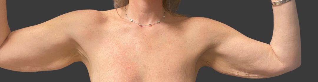 Brachioplasty Before & After