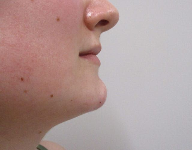 Chin Jawline Before & After