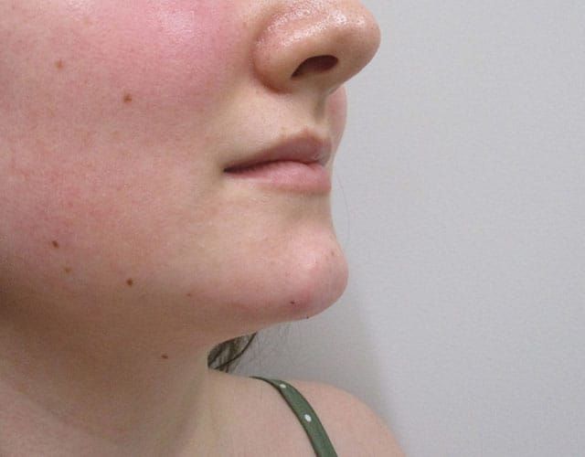 Chin Jawline Before & After