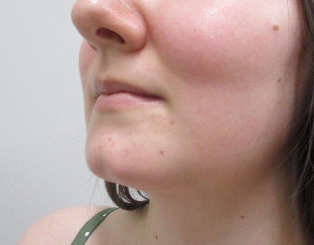 Chin Jawline Before & After