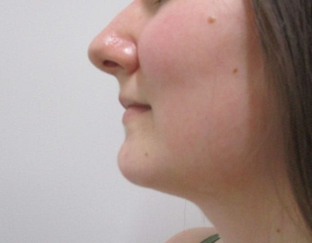 Chin Jawline Before & After