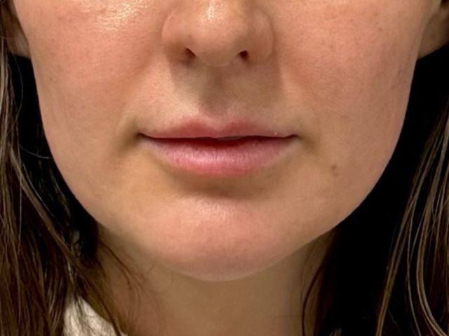 Chin Jawline Before & After