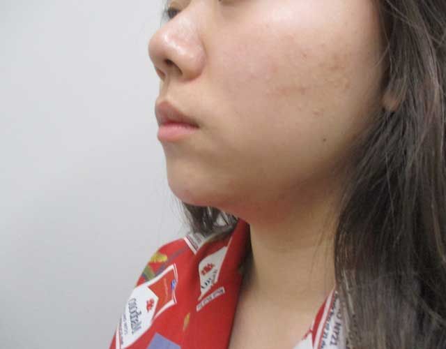 Chin Jawline Before & After