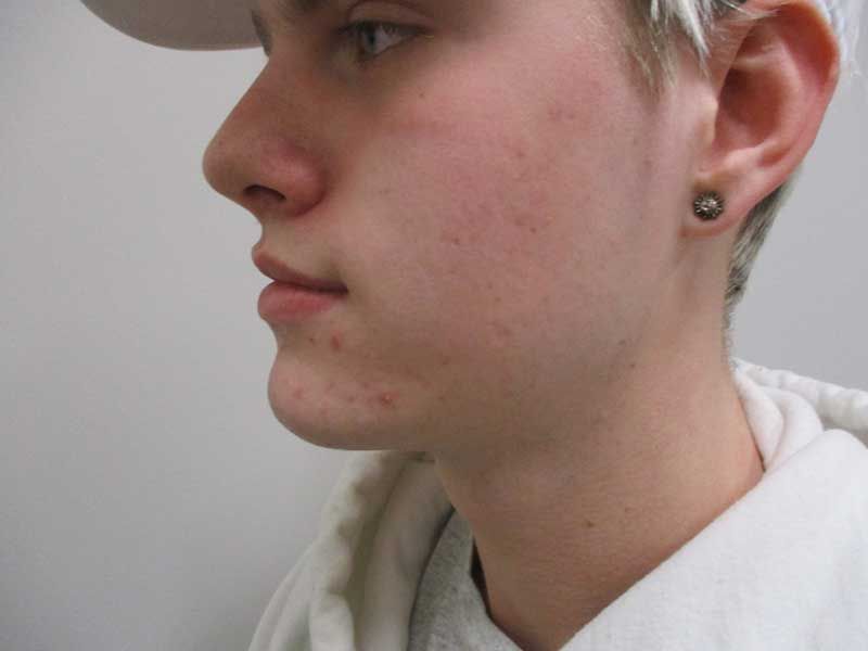 Chin Jawline Before & After