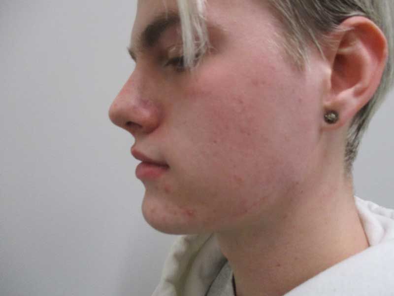 Chin Jawline Before & After