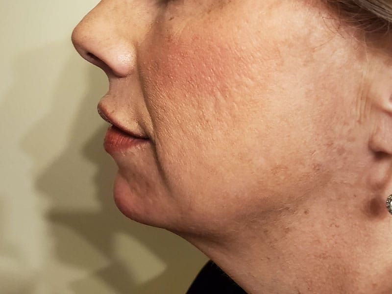 Chin Jawline Before & After