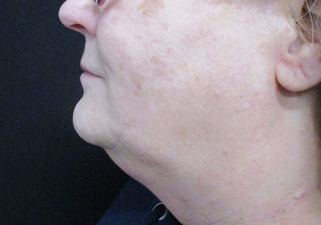 Chin Jawline Before & After