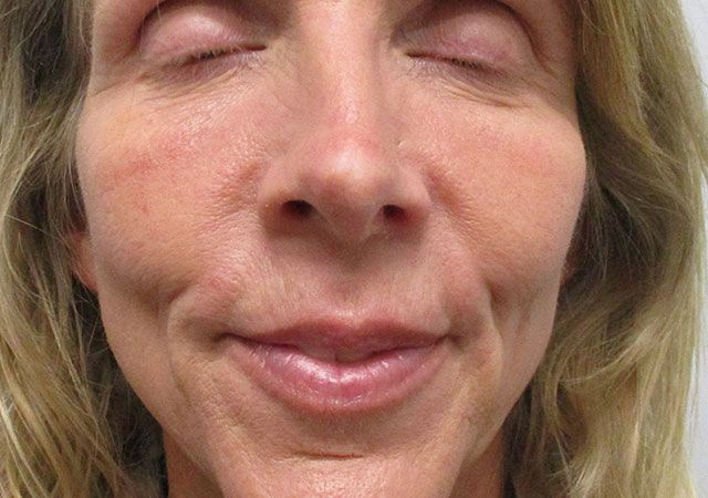 Chin Jawline Before & After