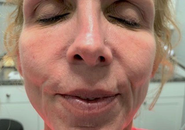 Chin Jawline Before & After