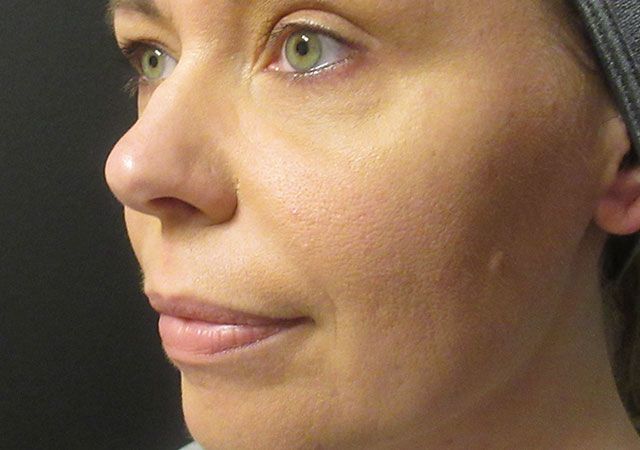 Chin Jawline Before & After