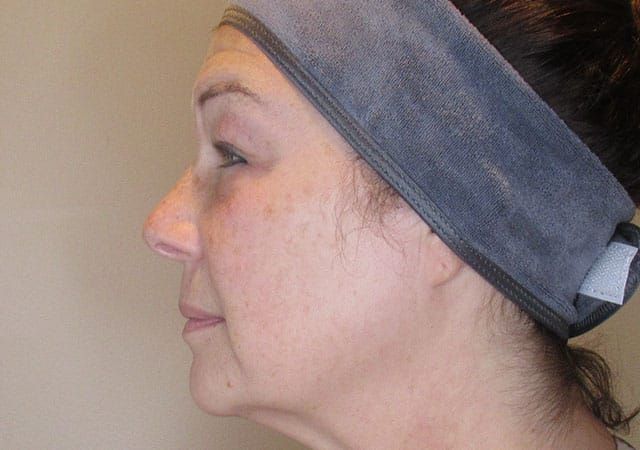 Chin Jawline Before & After