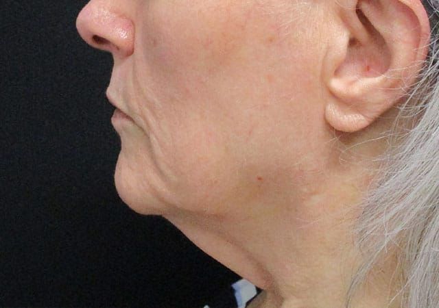 Chin Jawline Before & After