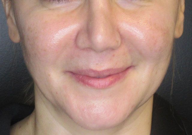 Chin Jawline Before & After