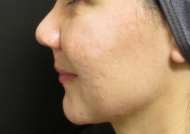 Chin Jawline Before & After