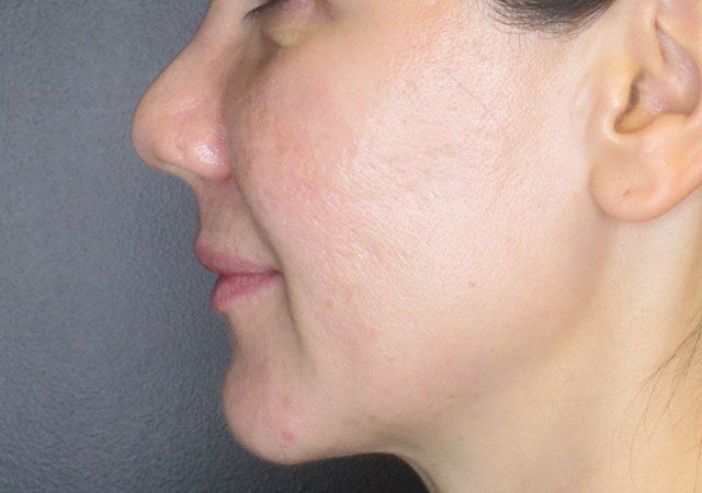 Chin Jawline Before & After