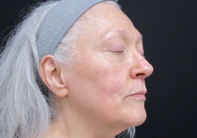 Chin Jawline Before & After