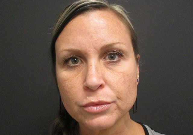 Chin Jawline Before & After