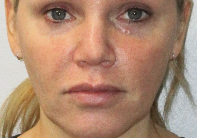 Chin Jawline Before & After