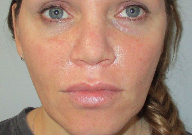 Chin Jawline Before & After