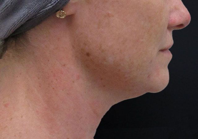 Chin Jawline Before & After