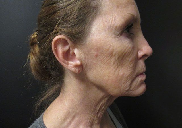 Chin Jawline Before & After