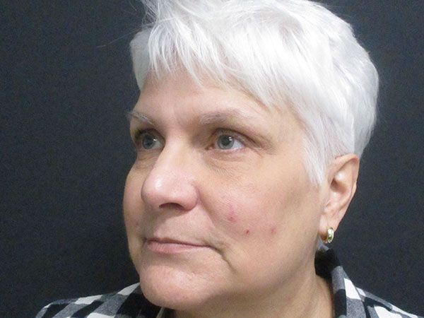 Chin Jawline Before & After