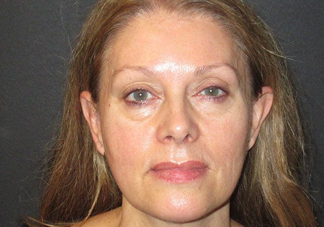 Chin Jawline Before & After