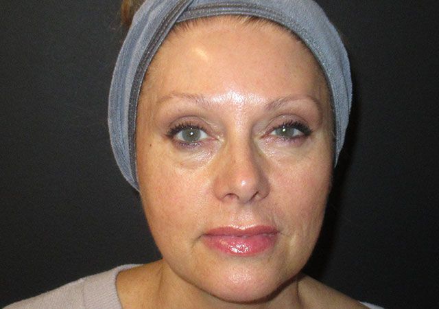 Chin Jawline Before & After