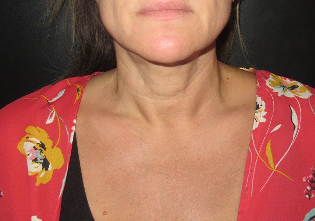 Chin Jawline Before & After