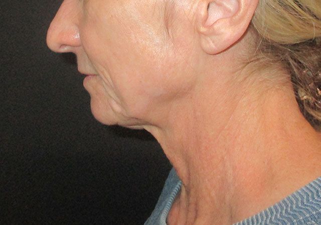 Chin Jawline Before & After