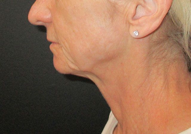 Chin Jawline Before & After