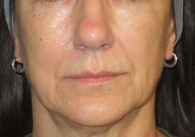 Chin Jawline Before & After