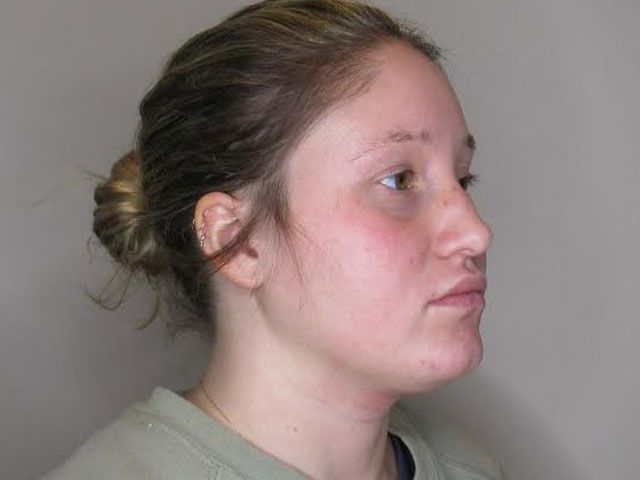 Chin Jawline Before & After