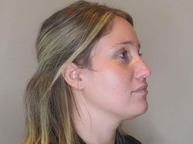 Chin Jawline Before & After