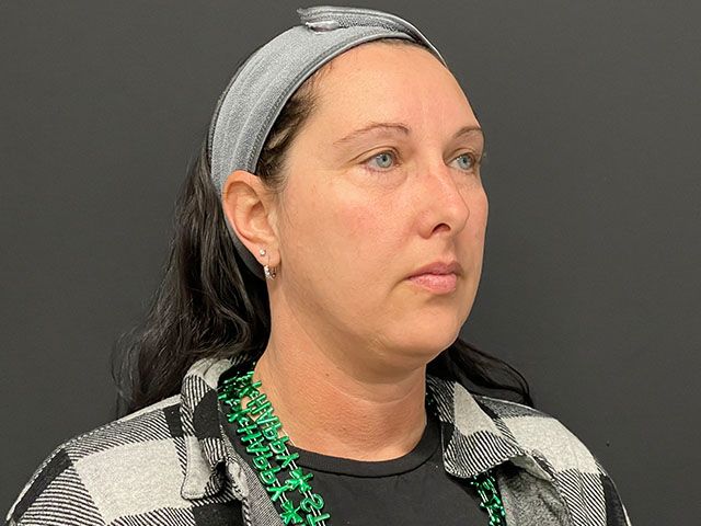 Chin Jawline Before & After