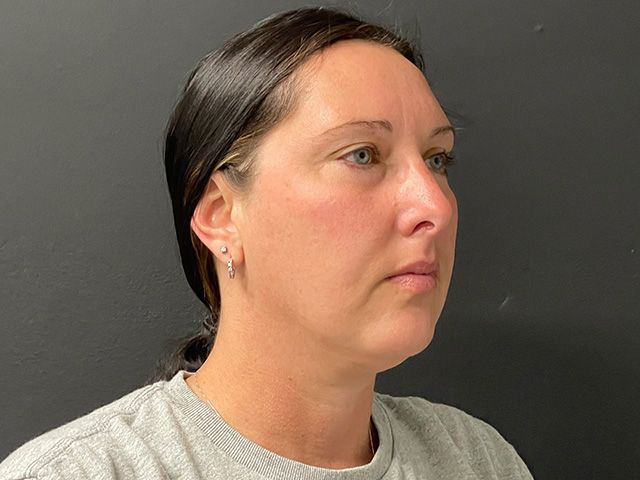 Chin Jawline Before & After