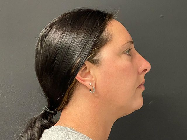 Chin Jawline Before & After