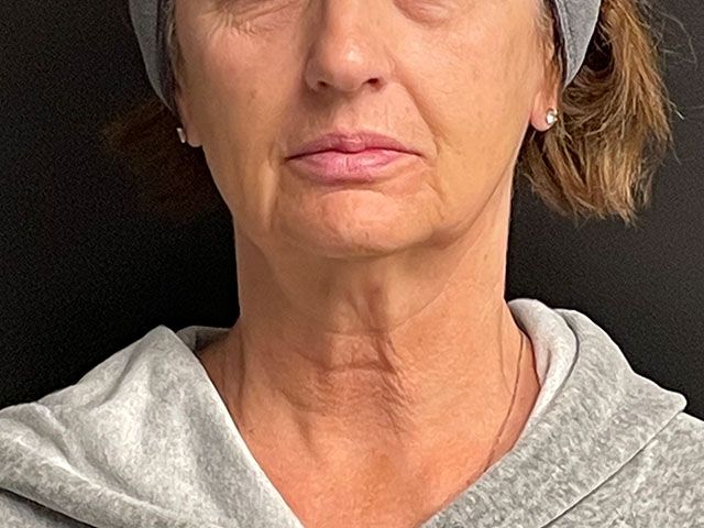 Chin Jawline Before & After