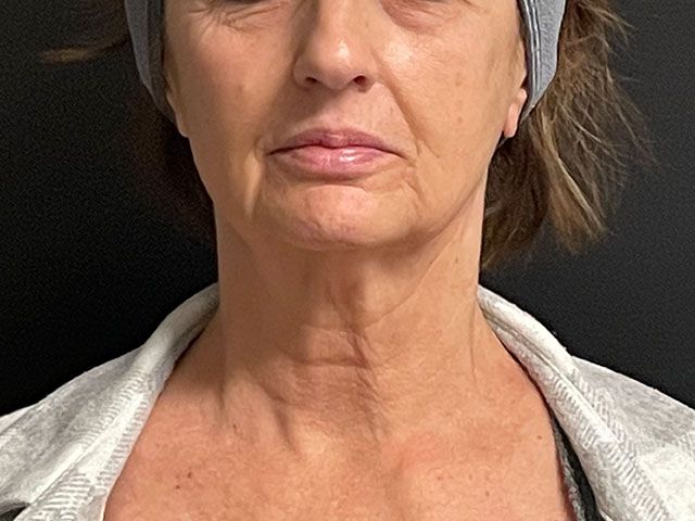 Chin Jawline Before & After