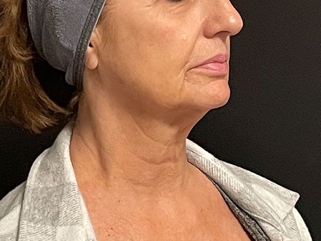 Chin Jawline Before & After