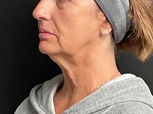 Chin Jawline Before & After