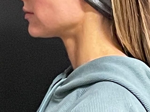 Chin Jawline Before & After