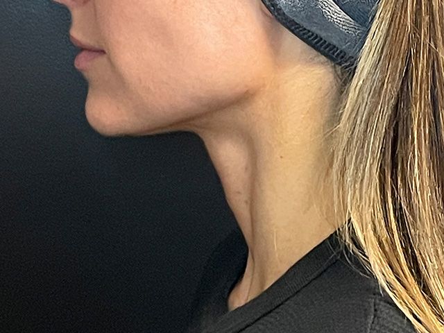 Chin Jawline Before & After