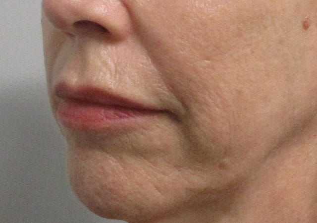 Chin Jawline Before & After